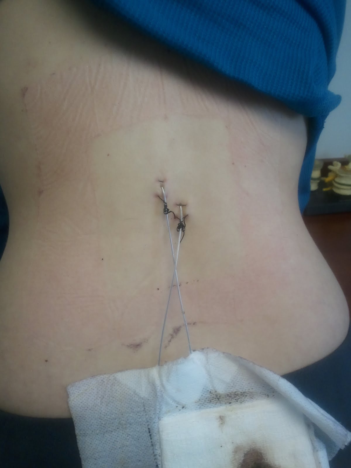 Under what circumstances is a trial of spinal cord stimulation considered for a patient?
